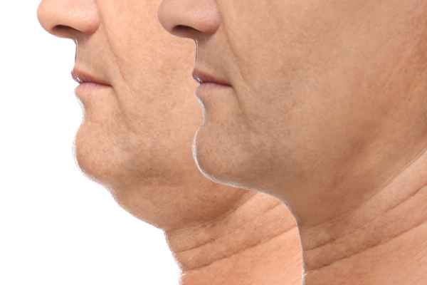 HIFU - Breakthrough in Anti - ageing 2 hifu results West Bridgford