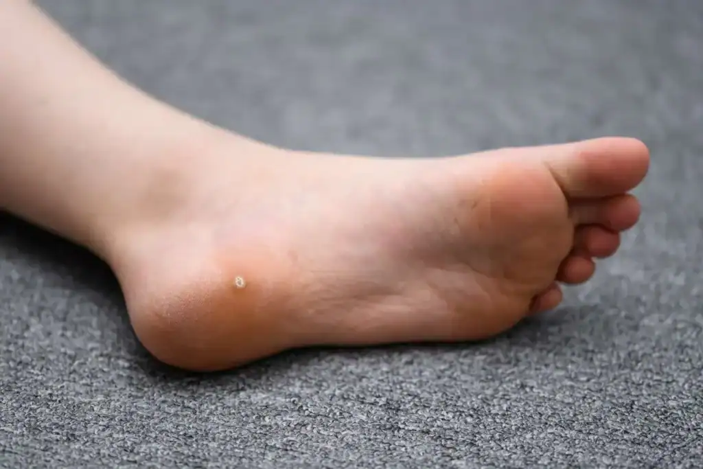 Cryotherapy For Warts And Also Verrucas 2 Image of verruca on the bottom of the foot that able to be treated with Cryotherapy West Bridgford