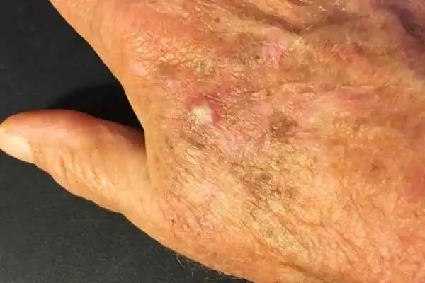 Image of Actinic keratoses West Bridgford on a person hand