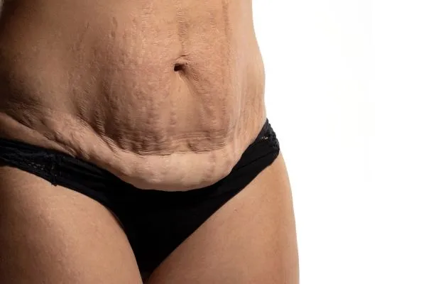 The science behind skin tightening West Bridgford picture of a woman's sagging skin on the stomach